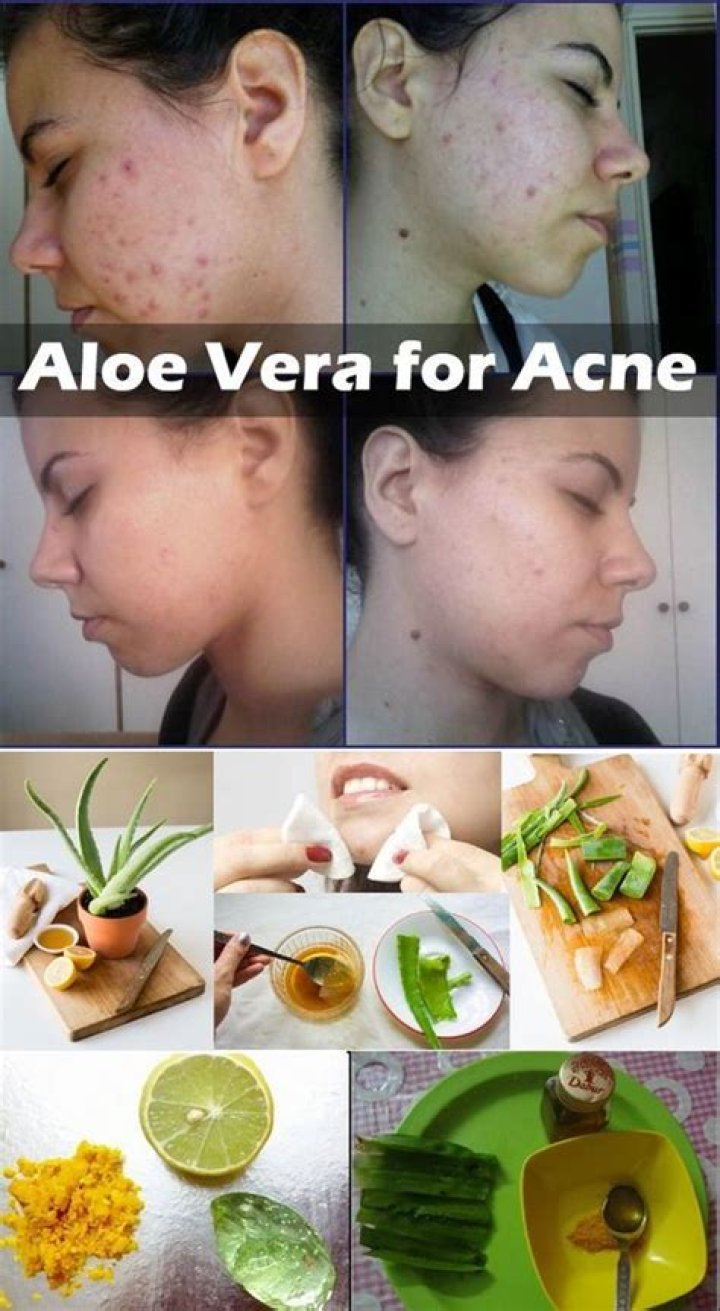 Is aloe vera and lemon good for acne?